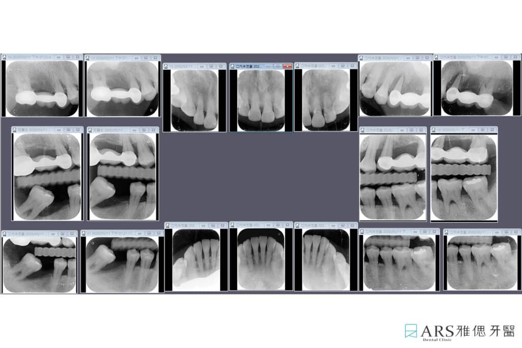 牙周病治療影像檢查