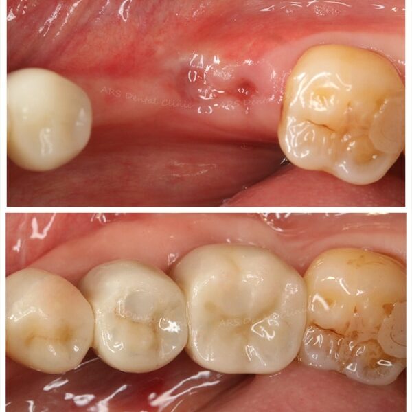 Z-Implant #34#35 (1858)