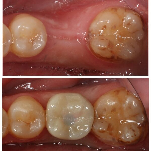 Z-Implant #36 (9307)