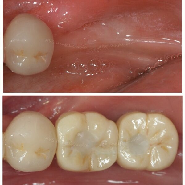 Z-Implant #36#37 (2511)