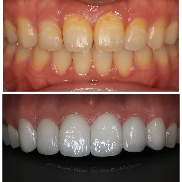 Q-Veneer#13-#23 (9749) G