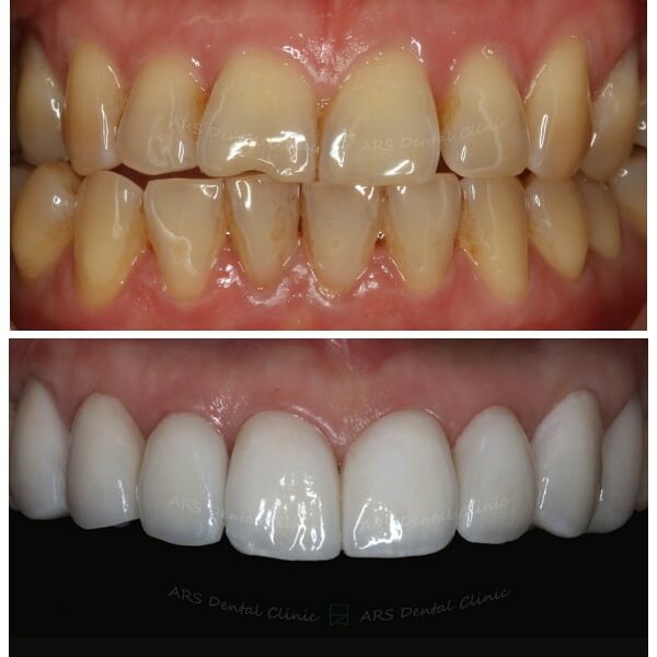 Q-Veneer#14-#24 (13359) G