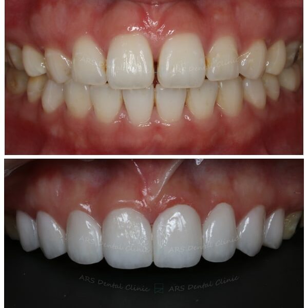 Q-Veneer#14-#24 (13465) G