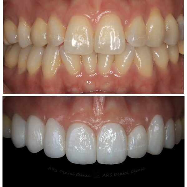 Q-Veneer#14-#24 (14084) G