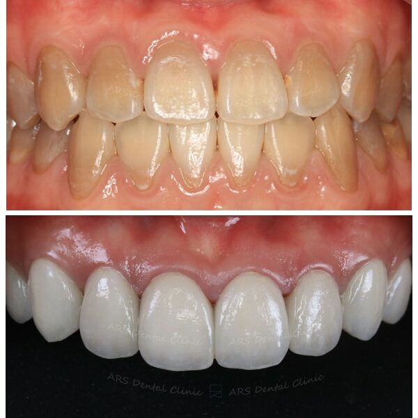 Q-Veneer#14-#24 (14379) G