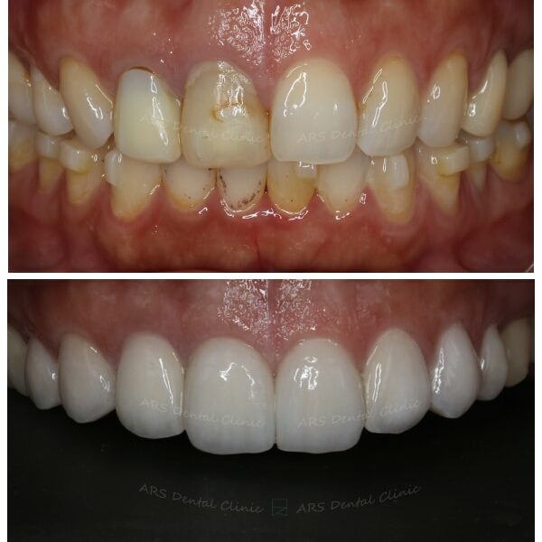 Q-Veneer+全瓷冠#13-#23 (11553) G