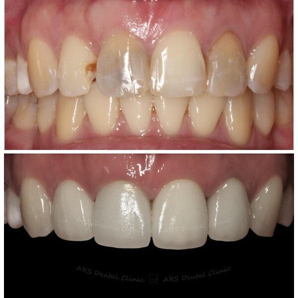 Q-全瓷冠#12-#22 (3618) G