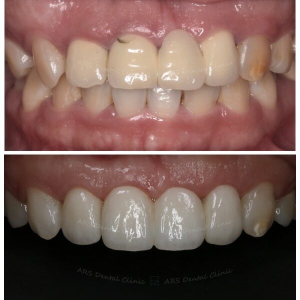 Q+C-C.L.S#13-#23&全瓷冠#12-#22 (7915) G