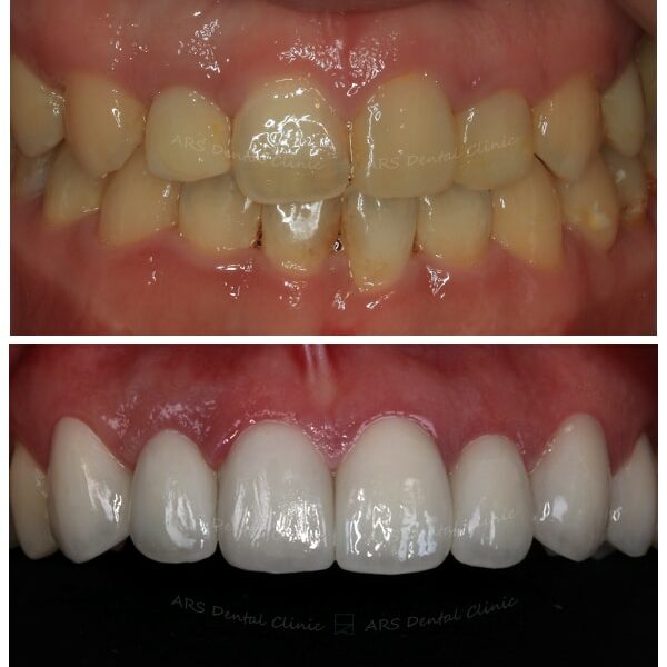 Q+C-C.L.S#14-#24&Veneer+全瓷冠#13-#24 (13766) G