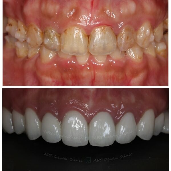 Z-C.L.S#14-#24&全瓷冠#15-#25 (5667) G √