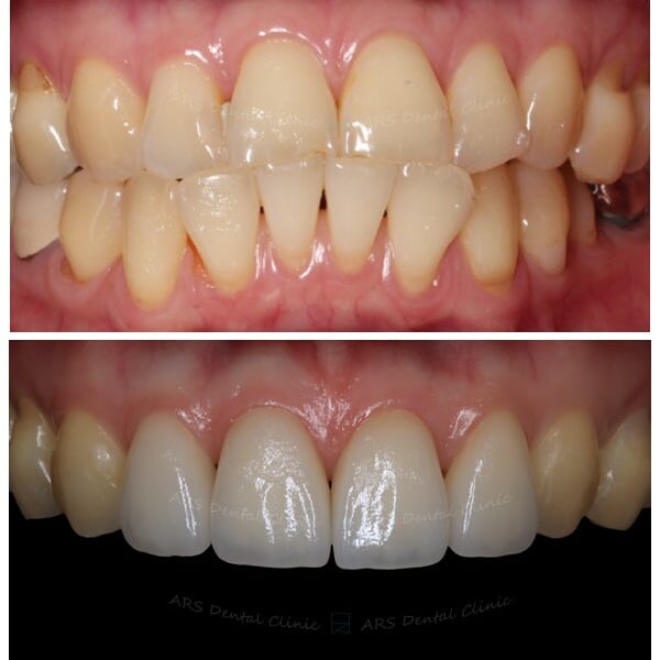 Z-Veneer#12-#22 (4056) G