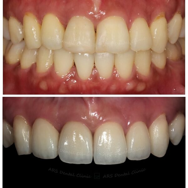 Z-Veneer+全瓷冠#12-#22 (6356) G