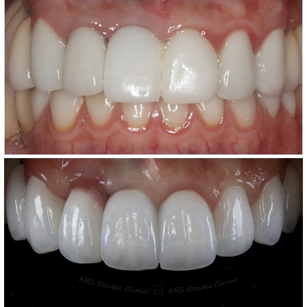 Z-implant#12&全瓷冠#14-#24 (12371) G