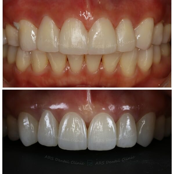 Z-全瓷冠#13-#23 (13500) G