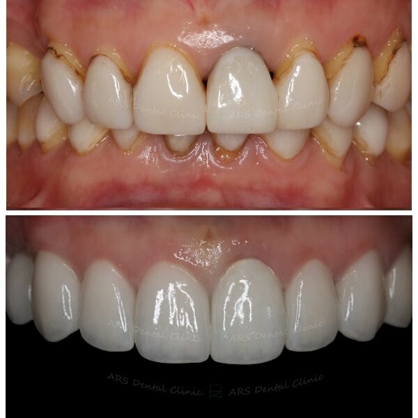 Z-全瓷冠#14-#24 (11119) G