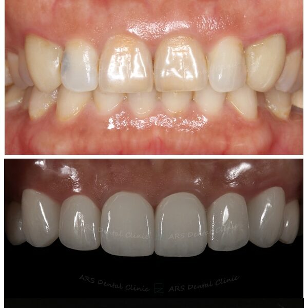 Z-全瓷冠#14-#24 (12536) G