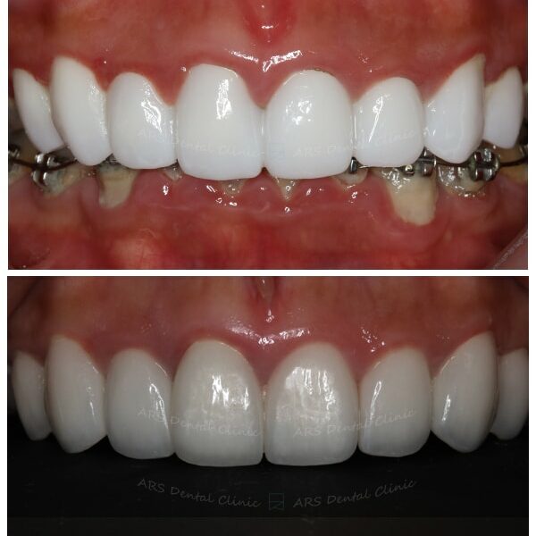 Z-全瓷冠#14-#24 (14237) G