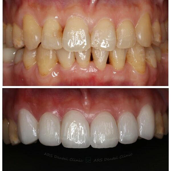 Q-Veneer#13-#23 (10766) G