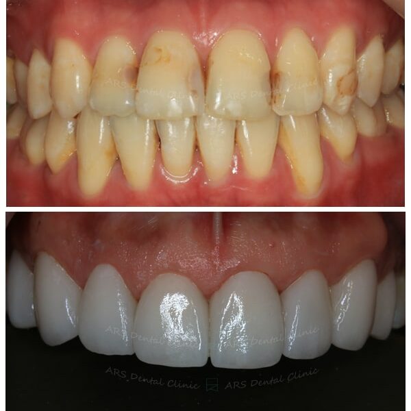 Q-Veneer#15-#25 (10481) G