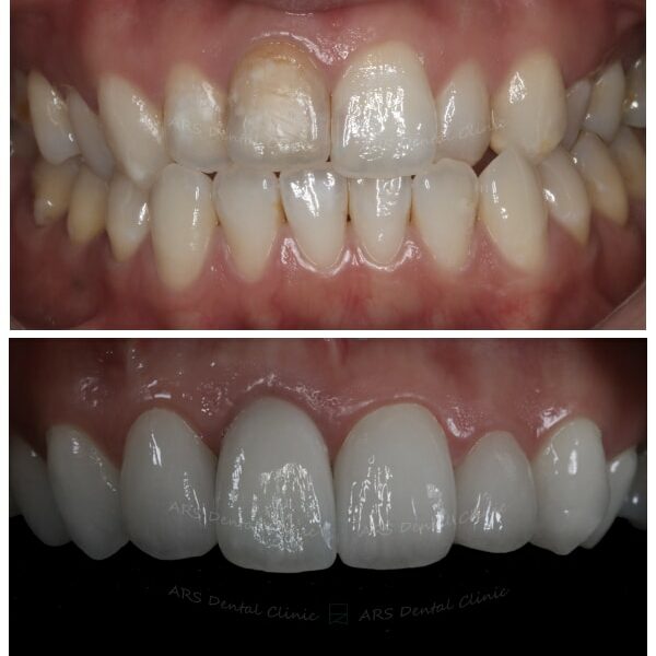 Z-Veneer+全瓷冠#12-#22 (13048) G