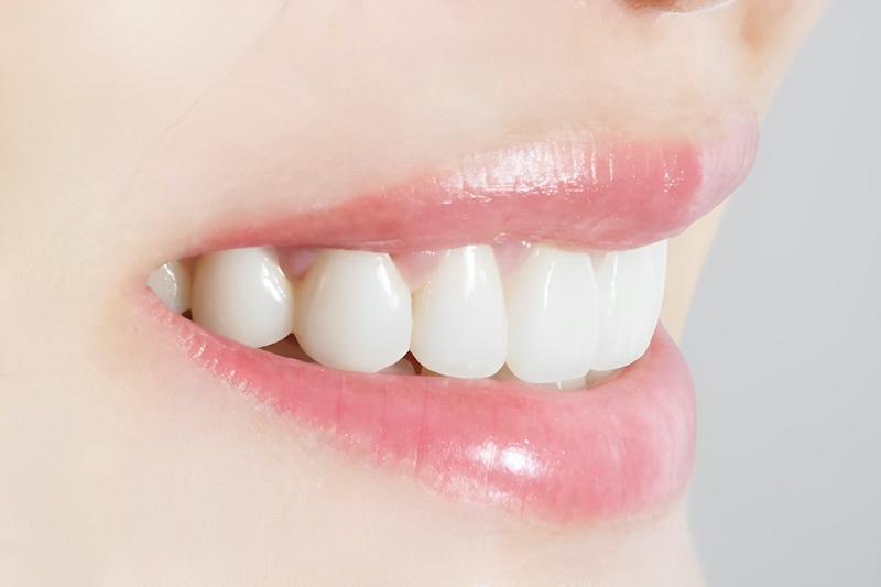 台北雅偲牙醫診療項目-陶瓷貼片-全瓷冠